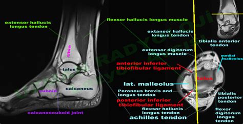MRI ankle - Google Search | Medical anatomy, Foot anatomy, Mri