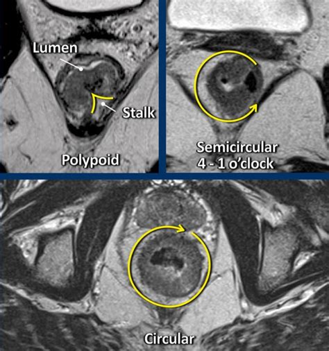 The Radiology Assistant : Rectal Cancer MR staging 3.0