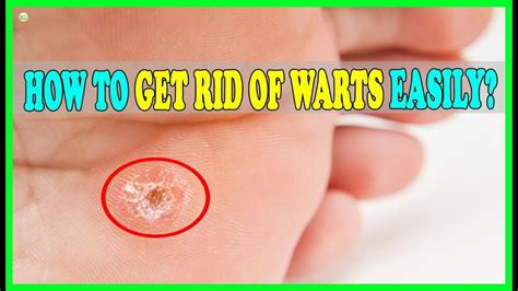 Common Warts On Feet / Pedicure tools ulta, home remedies for plantar warts on ... - Common ...