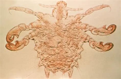 Crabs (STD) Symptoms, Treatment, Pictures | STD Crabs