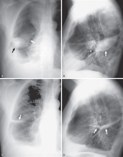 Loculated Pleural Effusion Radiology - 1 - Conventional chest ...