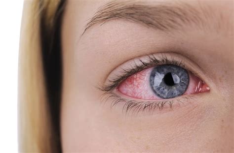 Cluster Of Eye Syphilis In Michigan Women Linked To One Man, CDC Says – Sci + Tech