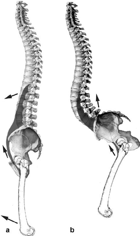 Hip flexion contracture (a) could be responsible for the onset of... | Download Scientific Diagram