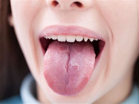 Red Spots on Tongue, Under, Back, Tip of Tongue - American Celiac