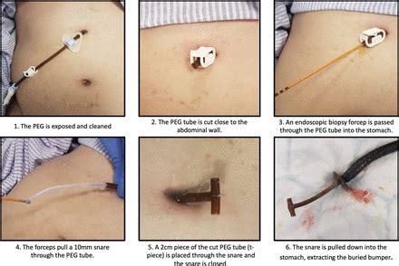 PWE-006 The T-piece pull technique removal of PEG buried bumpers – a quick novel endoscopic ...