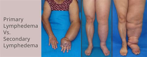 The Difference Between Primary and Secondary Lymphedema | Lymphedema, Lymphedema treatment ...