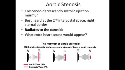 Aortic Stenosis [USMLE Highly Tested Topic] - YouTube