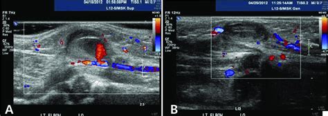 A) Ultrasound (US) doppler images showing a pseudoaneurysm originating... | Download Scientific ...