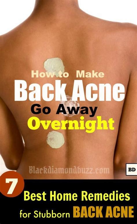 How to Get Rid of Back Acne Fast – 7 Best Home Remedies for Backne | Body acne remedies, Back ...