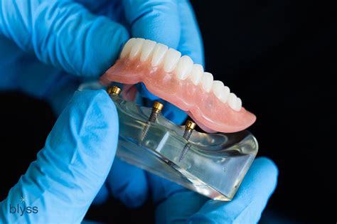 Snap In Dentures: Everything You Need to Know About Overdentures