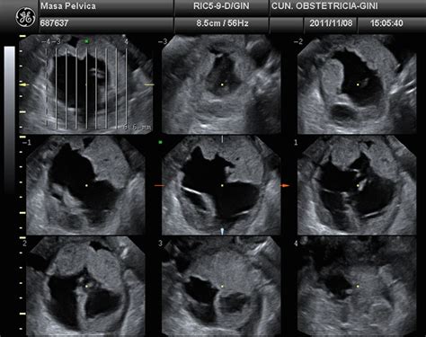 Tomographic ultrasound imaging (TUI) displays the lesion in several ...