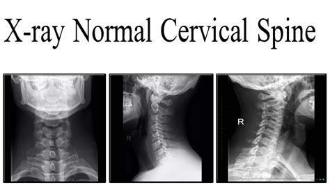 Healthy Cervical Spine Xray