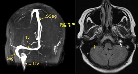 Venous sinus thrombosis - Radiology at St. Vincent's University Hospital