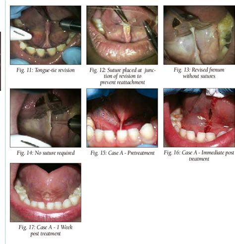 Oral Diagnosis of Abnormal Frenum Attachments in Neonates and Infants: Evaluation and Treatment ...