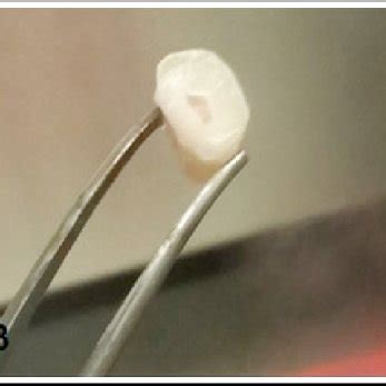 Collection of dental pulp tissue from extracted tooth. (1A) Cutting... | Download Scientific Diagram