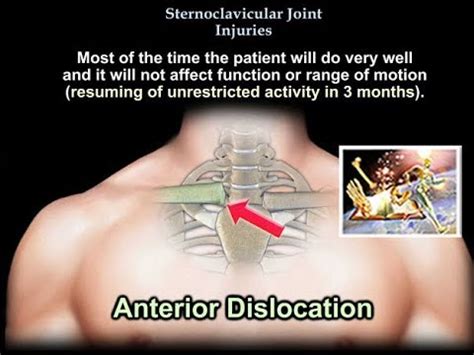 Sternoclavicular Joint Injuries - Everything You Need To Know - Dr ...