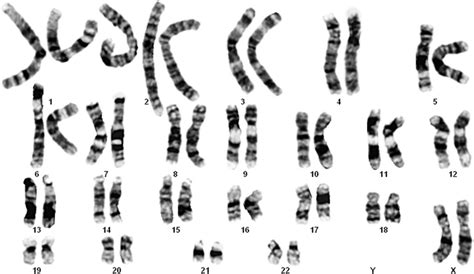 A karyotype of 47,XX,þ2. | Download Scientific Diagram