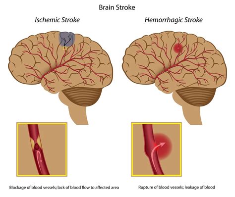 Should I give aspirin to someone having a stroke? – First aid for free