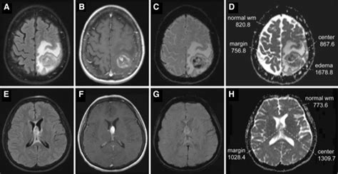 Imaging: Magnetic resonance imaging of PCNSL in the immunocompromised... | Download Scientific ...