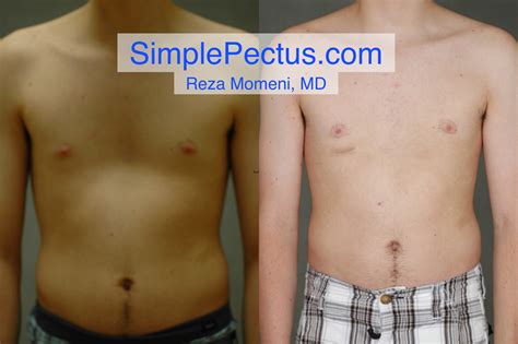 SIMPLE Pectus Repair Before & After Photo Gallery — Simple Pectus Excavatum Repair