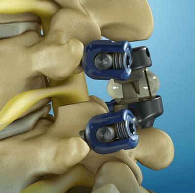 Premia Spine’s TOPS™ Facet Replacement Demonstrates Significant Improvement in All Patient ...