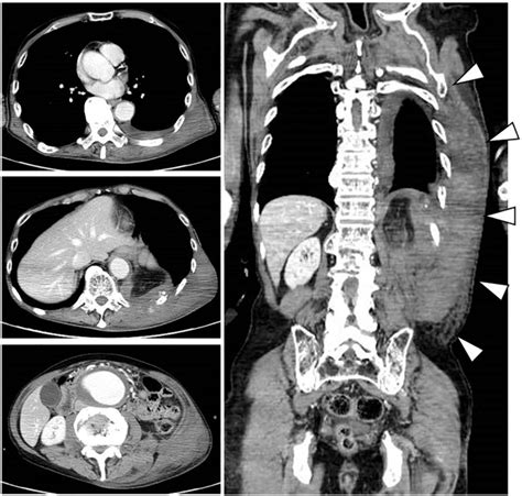 Imaging with CT angiography (CTA) from the chest to the pelvis... | Download Scientific Diagram