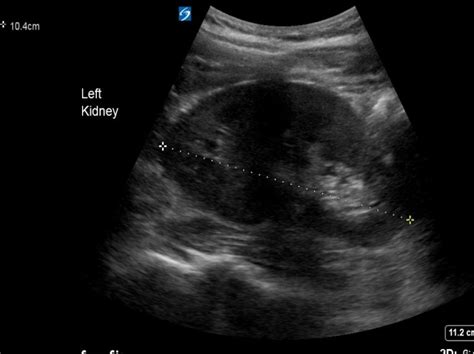 Renal colic - the twinkle artifact - Critical Care Sonography