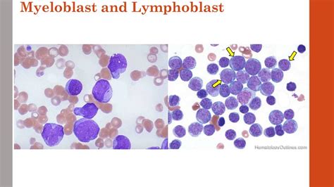 PPT - Lecture 4 and 5 Leukemia and Chronic myeloproliferative disorders ...