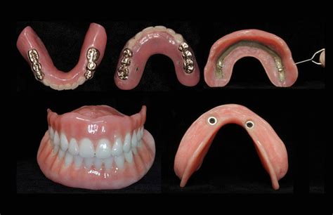 Snap-On Dentures - Dr. Eskow Prosthodontics