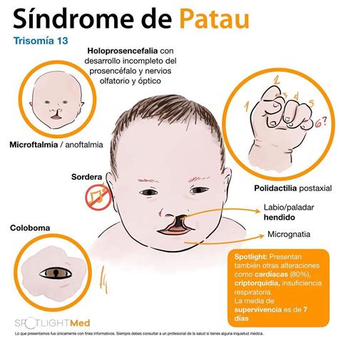 Síndrome de Patau 👶🏼 #SpotlightMed #Spotlight #Spotlightmedicine #medlife … | Obstetricia y ...