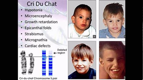 Chromosome Abnormalities List