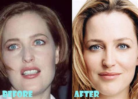 Gillian Anderson Plastic Surgery Before and After Pictures - Lovely Surgery | Celebrity Before ...