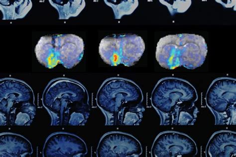 MRI sensor allows neuroscientists to map neural activity with molecular precision | Kurzweil