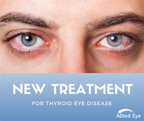 New Treatment for Thyroid Eye Disease