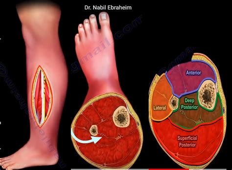 Single incision fasciotomy for Compartment syndrome — OrthopaedicPrinciples.com