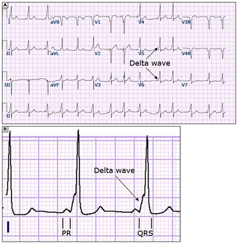 delta wave ecg