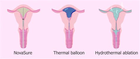 What Is Endometrial Ablation? - Procedure, Recovery & Pregnancy