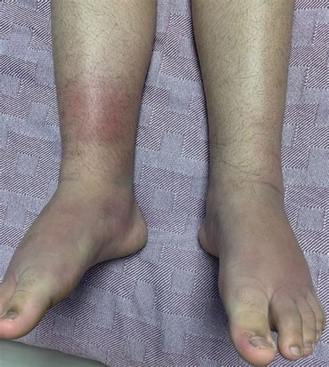 Bilateral leg swelling as the presenting symptom of Löfgren syndrome in a paediatric patient: a ...