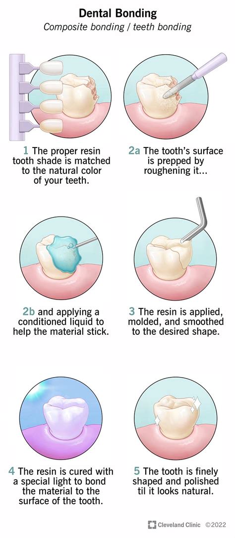 Dental Bonding: What is Teeth Bonding & What to Expect