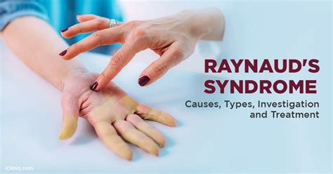 Raynaud's Syndrome: Symptoms, Causes Treatment, 43% OFF