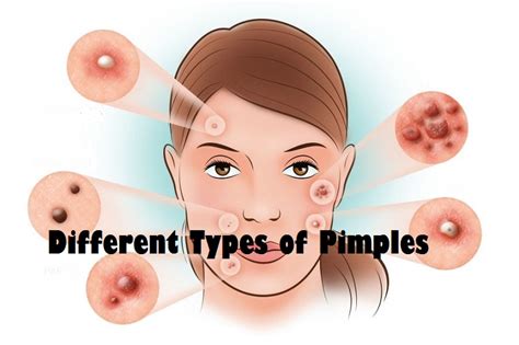 Most Common Causes and Different Types of Pimples - Healthy Flat