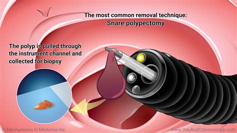 Slide Show - What happens during and after a colonoscopy?