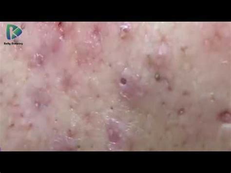 Remove Big Back Blackheads Part#2 - YouTube