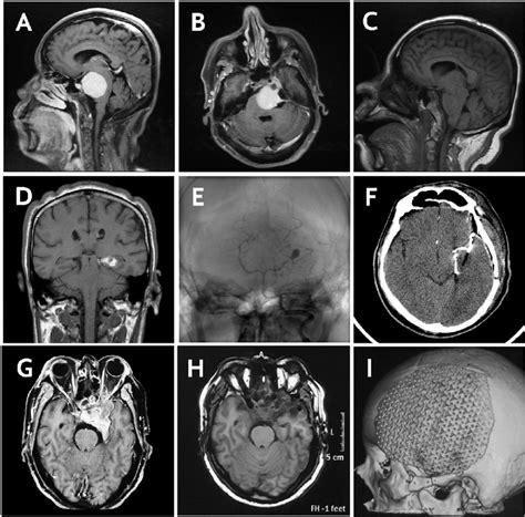 Clinical cases' images. Case 1: contrasted MRI images showing a giant... | Download Scientific ...