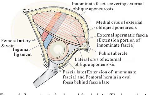 [PDF] Femoral Hernia: A Review of the Clinical Anatomy and Surgical Treatment | Semantic Scholar