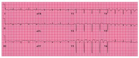 Lv Apical Aneurysm Ecg | Paul Smith