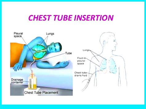 CHEST TUBE INSERTION AND MONITORING - Nurses note help