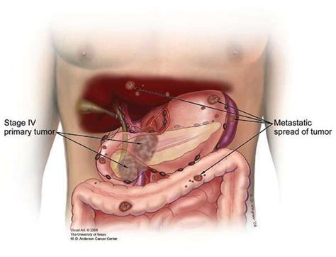 what happens end stage pancreatic cancer - Audrie Arellano