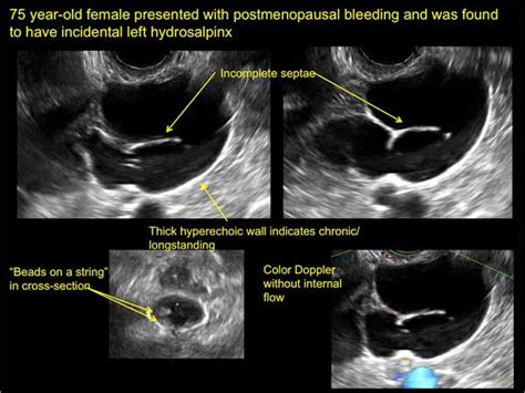 “Cogwheel” and other signs of hydrosalpinx and pelvic inclusion cysts | MDedge ObGyn