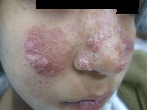 Cutaneous, visceral & mucocutaneous leishmaniasis symptoms & treatment